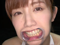 激レアな治療跡がある歯・口内・のどちんこ観察！美泉咲