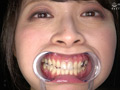 優木なおチャンの銀歯だらけの激レア歯・口内観察！！！