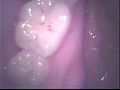 歯03