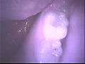 歯03
