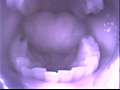 歯03
