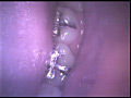 歯16