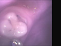 歯19