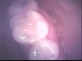 歯18