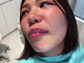 本物歯科治療映像 左下6，7番銀歯治療 星野桃子