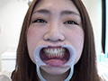 歯フェチ！本物歯科治療映像 親知らず抜歯 芹沢かえで
