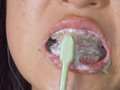 30代から始めた矯正を徹底鑑賞！歯列矯正中の熟女