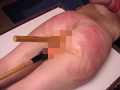 Burning pain