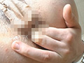 パックリ肛門